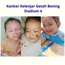 Kanker Kelenjar Getah Bening Stadium 4
