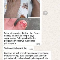 luka cepat kering