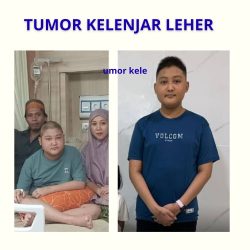 tumor kelenjar leher