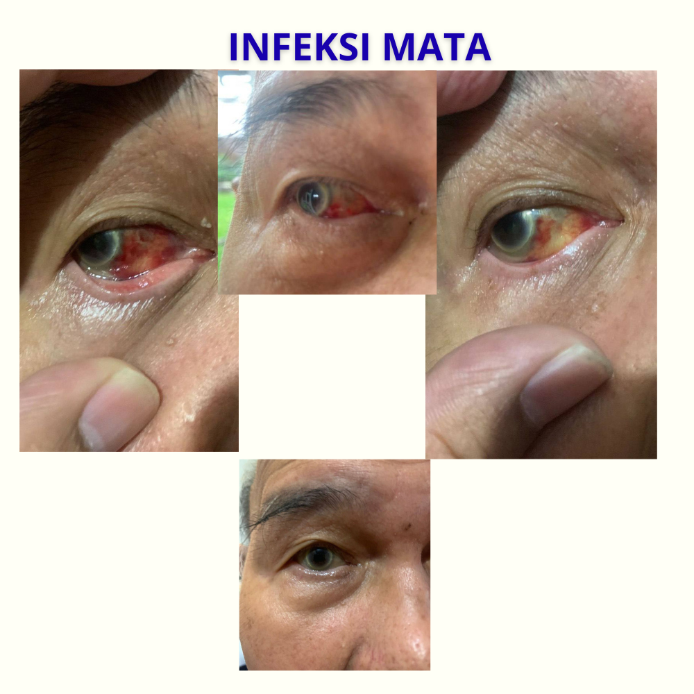 INFEKSI MATA