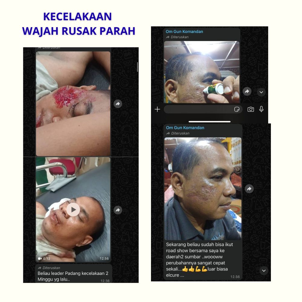 KECELAKAAN - WAJAH RUSAK