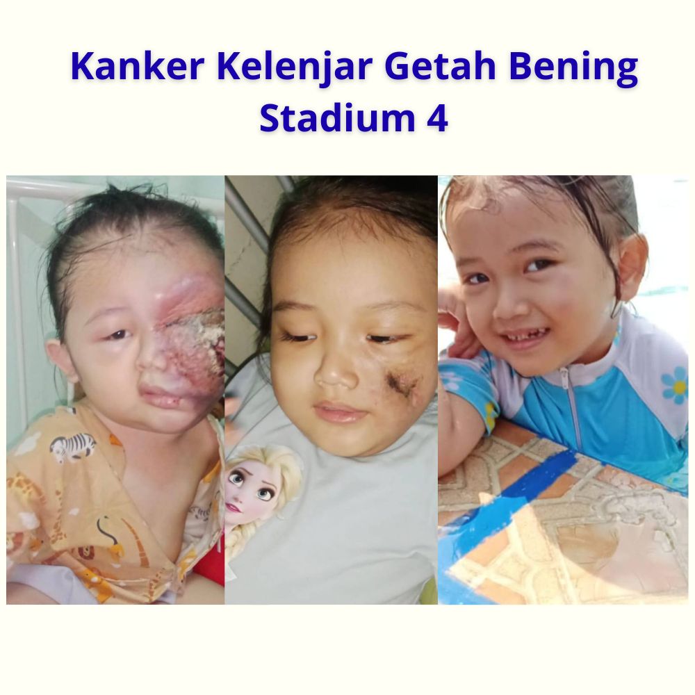 Kanker Kelenjar Getah Bening Stadium 4