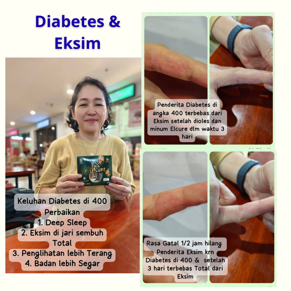 diabetes dan eksim