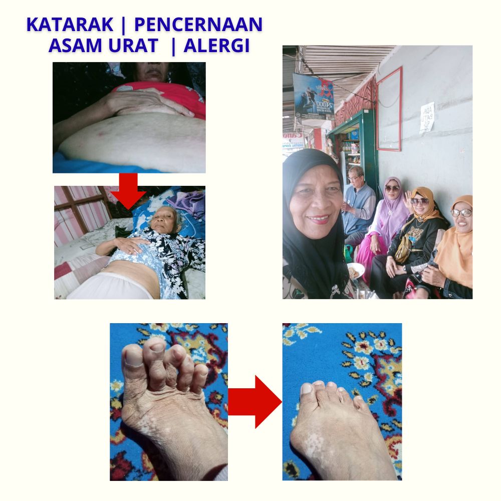 katarak-pencernaan-asam urat-alergi