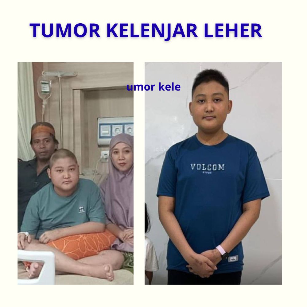 tumor kelenjar leher
